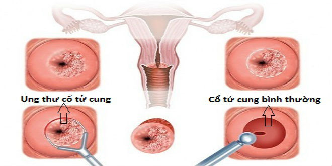 các yếu tố nguy cơ và cách tầm soát ung thư cổ tử cung
