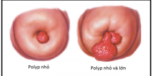 polyp cổ tử cung