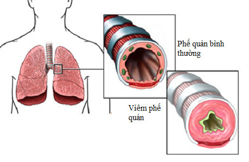 Viêm phế quản cấp