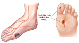 loét bàn chân do tiểu đường