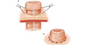 Hậu môn nhân tạp kiểu đầu tận