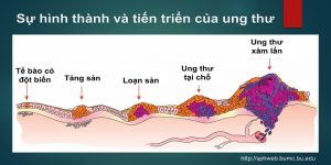 ung thư biết sớm trị lành 3