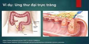 ung thư biết sớm trị lành 4