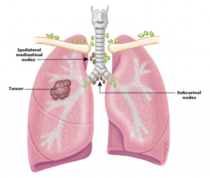 điều trị ung thư phổi tế bào nhỏ 3