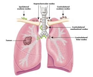 điều trị ung thư phổi tế bào nhỏ 4