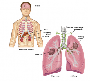 điều trị ung thư phổi tế bào nhỏ 5