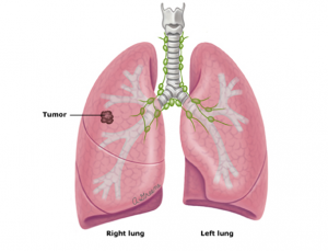 ung thư phổi tế bào nhỏ 1