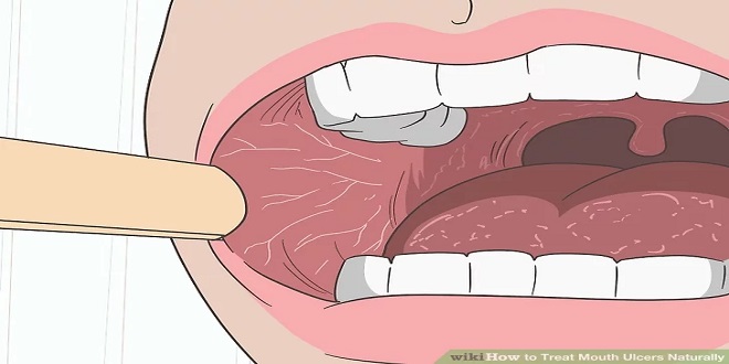 Đau và viêm loét miệng