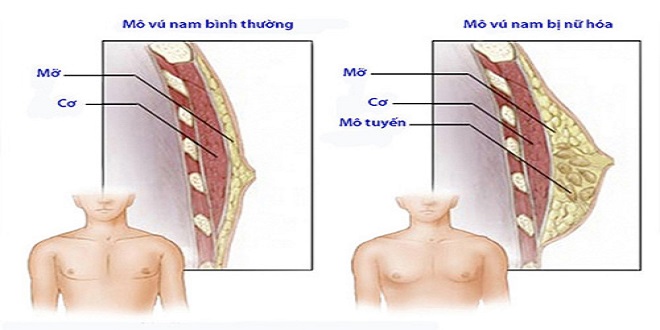 Phì đại tuyến vú ở nam