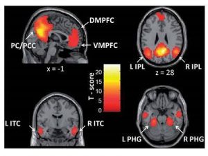 (f-MRI) Sự kích hoạt của các vùng não thuộc " Mạng chế độ mặc định "(DMN)