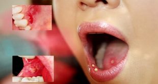 các bệnh trong khoang miệng thường gặp