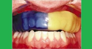 Bảo vệ răng với dụng cụ bảo vệ hàm (mouthguards)