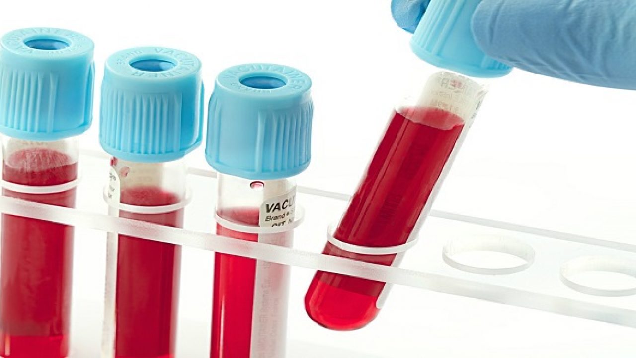 Các xét nghiệm máu phát hiện viêm - Y Học Cộng Đồng