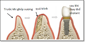 phẫu thuật nâng xoang và tái tạo sống hàm