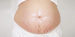 Những thay đổi ngoài da ở phụ nữ có thai