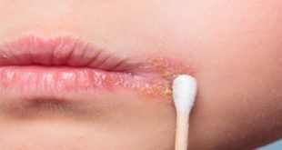 tổng quan về bệnh Herpes môi (mụn rộp môi)