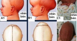 dị tật dính khớp sọ sớm ở trẻ em