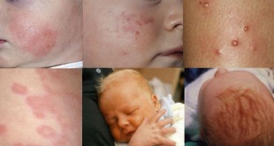 Một số hình ảnh về phát ban, bất thường, nhiễm trùng da ở trẻ