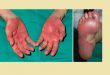 Hội chứng tay-chân hoặc đỏ da và dị cảm lòng bàn tay-bàn chân