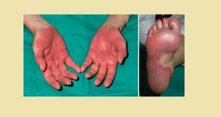 Hội chứng tay-chân hoặc đỏ da và dị cảm lòng bàn tay-bàn chân