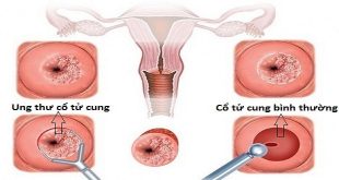 Ung thư cổ tử cung và cách phòng ngừa