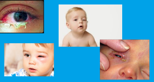 Tình trạng và bệnh lý mắt trẻ em