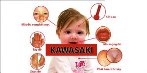 Bệnh Kawasaki