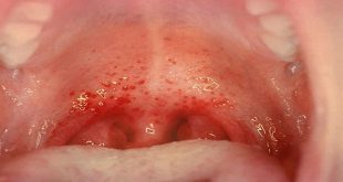 Viêm họng và amiđan do liên cầu khuẩn