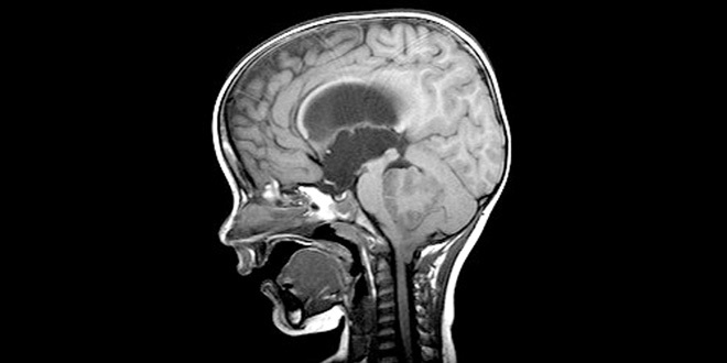 U màng não thất ở trẻ em: Giai đoạn và Phân độ