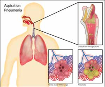 Viêm phổi hít - Y Học Cộng Đồng