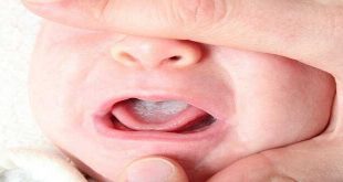 Loét miệng họng trong ung thư trẻ em