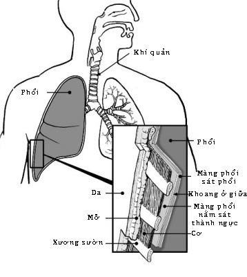 Tràn dịch màng phổi