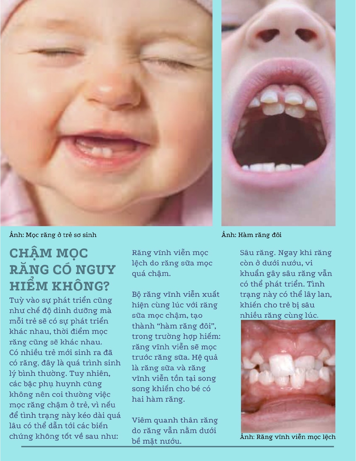 Trẻ chậm mọc răng sữa có đáng lo ngại?